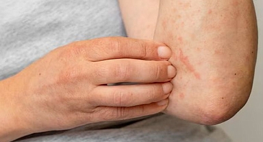 Bu hastalık kadınlarda 9 kat fazla görülüyor